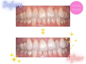 セルフホワイトニングサロン　エクシアホワイトニング　新白河店/ホワイトニングビフォーアフター