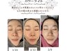 【人気No.1】シミ・シワ・毛穴でお悩みの方のトータルケア