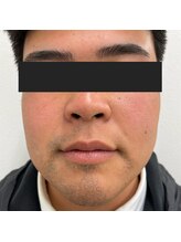 アールブイ(RV)/ヒゲ脱毛モニター