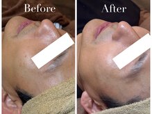 アブニールブリヨン/2BBioハーブピーリング/肌質改善