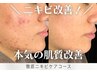 ＜ニキビお悩みの方｜HPB限定4回コース＞徹底ニキビケアコース〈毛穴・皮脂〉