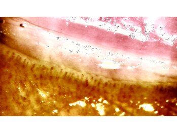 清耳み(shijimi)/毛細血管の観察