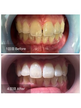 オーシャンハーブ(Ocean Harb)/【福井最安値のホワイトニング】