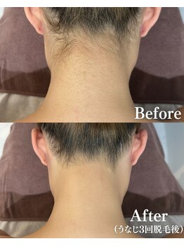 フェミューズアカサカ(FEMUSE AKASAKA)/全身脱毛