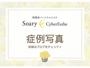 ソアリー バイ サイバーエステ(Soary×CyberEsthe)/ハイパーナイフ症例写真ご紹介♪