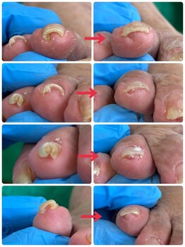 一宮巻き爪センター/巻き爪