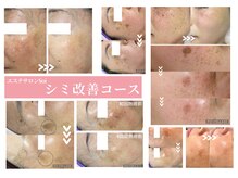 光2,000ショット＋プラズマ照射でしつこいシミに徹底アプローチ