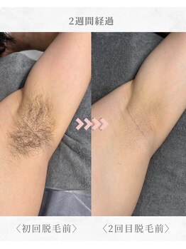 エール(AEELE)/■わき脱毛■