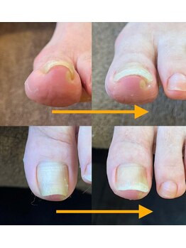 きよらか鍼灸接骨院の写真/軽度～重度の巻き爪矯正で整える！症状により金額が異なるケアで足元快適に