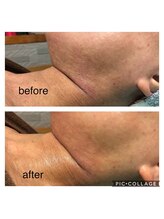 エスカル ボーテ(escale beaute)/かゆみ肌には酵素パックです