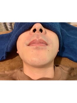 ケイナイン(K-9)/メンズヒゲ脱毛