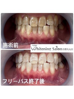 ホワイトニングサロン 京都烏丸店/ホワイトニング 施術例