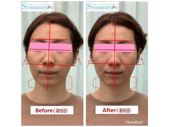 シンメトリー 池袋店/小顔美矯正ビフォーアフター