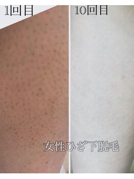 サロン ジジ(salon JiJi)/脱毛・女性膝下10回目
