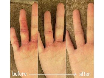 エミュ(emu)/ハーブケア &nbsp;お客様before/after