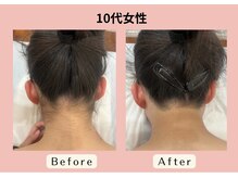 エピリス(EPILIS)/大人気のうなじ脱毛☆