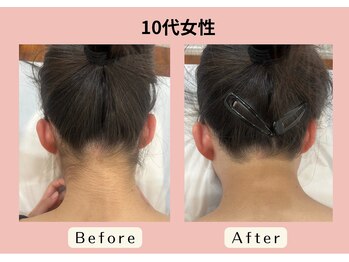 エピリス(EPILIS)/大人気のうなじ脱毛☆