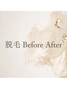 アンドユクス 国分寺(&uks)/脱毛 Before After