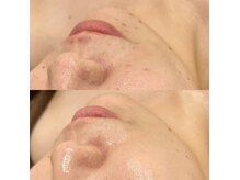 リオ(Rio)の雰囲気（REVIハーブピーリングお肌悩みに合わせたオプション多数ご用意）