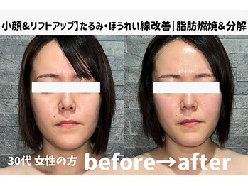 サロンスペース/30代 女性【小顔&リフトアップ】