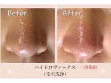 ラリリー(La Lily)/ソフトピーリング毛穴洗浄の効果