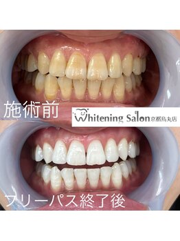 ホワイトニングサロン 京都烏丸店/ホワイトニング瀬術例