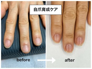 コバコ(kobaco)/縦長美爪へ　1年間の成果比較