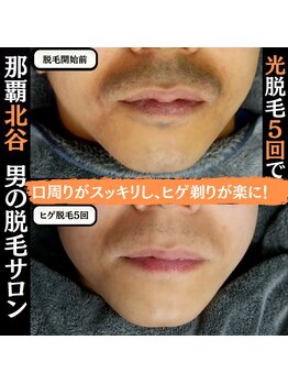 ディースタイル 北谷店(Dstyle)/北谷メンズ脱毛ヒゲBefore after