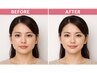 【顔のエラ張りや食いしばり解消】フェイライン改善美容鍼+エラ張り矯正施術