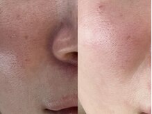 ユーヘン(uhem)/【PICO】幹細胞上清液施術症例