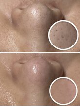 美肌脱毛専門店 パールプラス 大在店/毛穴洗浄