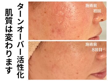 エリン(ERIN)/ハーブピーリング