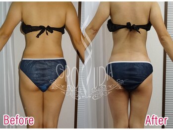 グラウディア 恵比寿/痩身/筋膜リリース/インディバ超