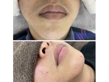 カルディエ(Cardie)/ひげ脱毛　ビフォーアフター