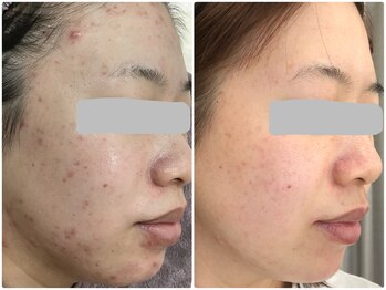 ベルネ(BELLUNE)/ベルネ式ニキビケア