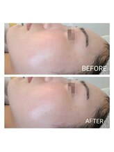 リンド(Lindo)/エステ版マッサージピール