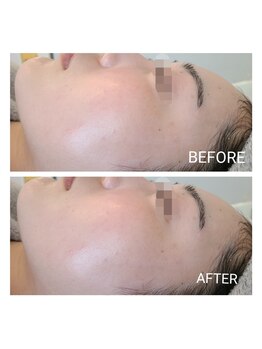 リンド(Lindo)/エステ版マッサージピール