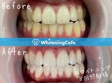 ホワイトニングカフェ 仙台店(WhiteningCafe)/☆歯のホワイトニング施術写真☆