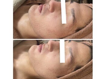 ホワイトアクア 岐阜店(WHITE AQUA)/ハーブピーリング/岐阜/ニキビ