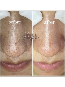 ニッカ(nikka)/毛穴ケア
