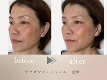 グロッシー(glossy)/【症例】プラズマ全顔リフトケア