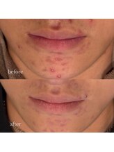 アーネスト 大阪心斎橋店(EARNEST)/韓国式光美容【 皮脂抑制ケア 】