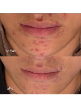 アーネスト 大阪心斎橋店(EARNEST)/韓国式光美容【 皮脂抑制ケア 】