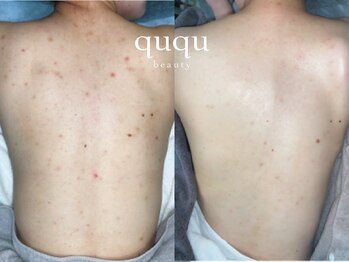 クク(ququ)/背中ピーリング