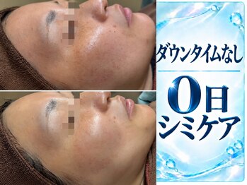 モアナ(MOANA)/ダウンタイム0日シミケア