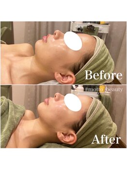 モット 神戸店(Motto)/フェイシャル 小顔矯正