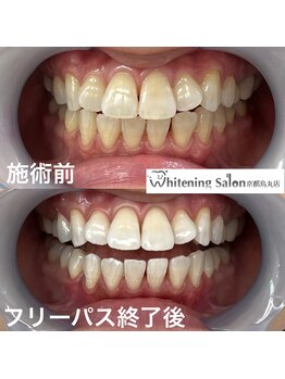 ホワイトニングサロン 京都烏丸店/ホワイトニング施術例