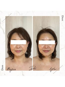 ディオン(Dion)/ビフォーアフター