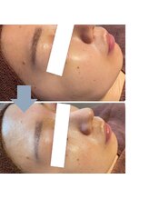 レベンディス(LEVENDIS)/ハーブピーリング