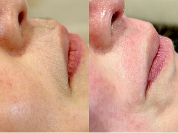 サロン ベベ(Salon Bebe)の写真/自信の持てる素肌美人へ★肌悩みはお任せ《スタッフイチオシ☆》艶玉フェイシャルWax!直後から効果実感◎